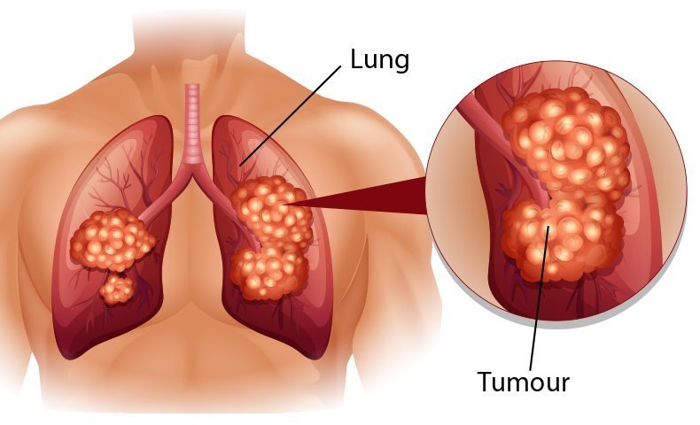 6 biện pháp phòng ung thư phổi