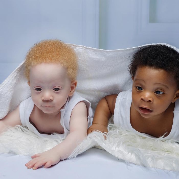 Hi hữu: bé sinh đôi có hai màu da khác nhau