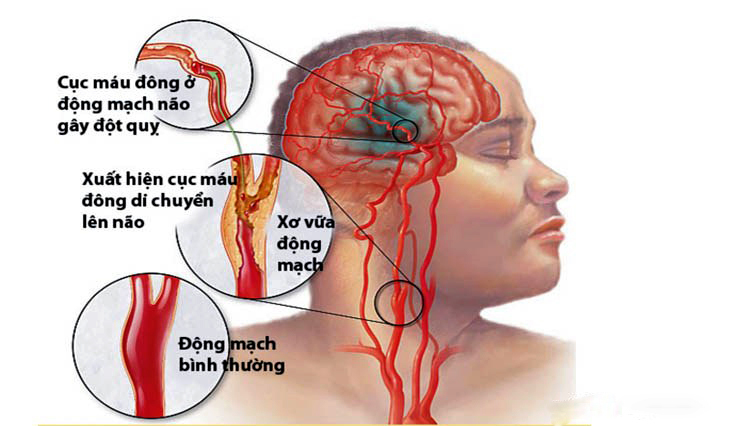 Đột quỵ trẻ hóa, cách ổn định huyết áp và phòng ngừa đột quỵ
