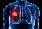 Hơn 20.000 người chết một năm: 5 dấu hiệu ung thư phổi bạn phải nhớ