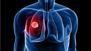 Hơn 20.000 người chết một năm: 5 dấu hiệu ung thư phổi bạn phải nhớ