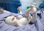 Trẻ sơ sinh ở Quảng Ninh mắc bệnh hiếm gặp, toàn thân bao phủ da dày bị rạn nứt thành từng mảng