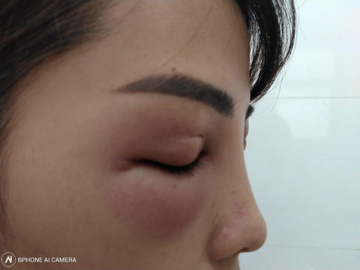 More cases of blindness after injecting filler to fill the cheek grooves at the hair salon, don't be beautiful despite it