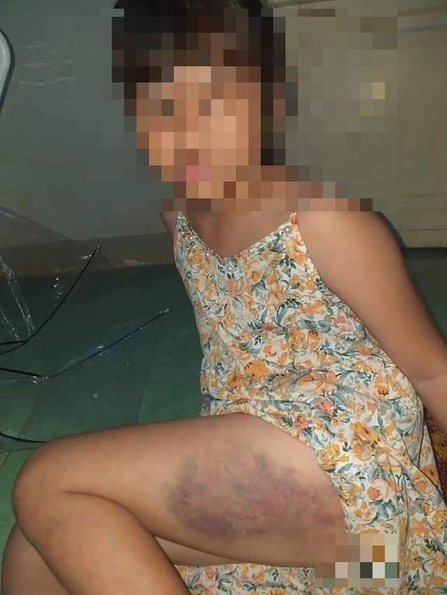 Nữ sinh lớp 3 bị cô giáo đánh bầm tím đùi