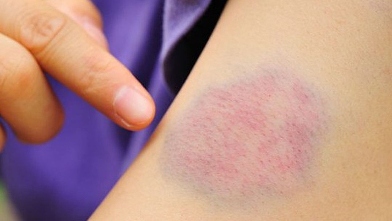 Bầm tím tay, chảy máu tự nhiên: Coi chừng căn bệnh nguy hiểm, ở viện nhiều hơn ở nhà