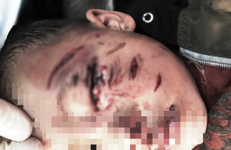 Nghệ An: Bé trai 2 tuổi bị chó nhà cắn rách mặt, tổn thương mắt - Ảnh 1.
