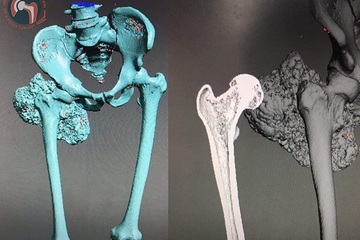 Nghiên cứu vật liệu y sinh 3D của các nhà khoa học Việt