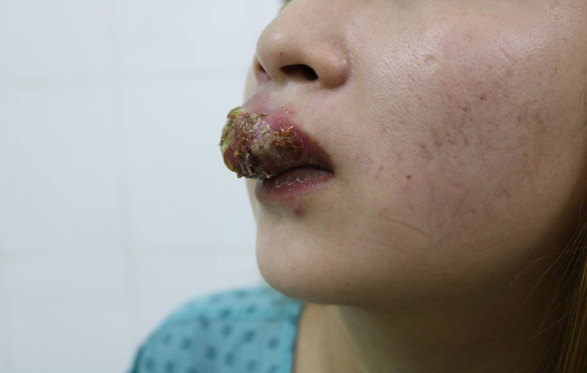 Nhập viện điều trị vì môi sưng vù sau khi xăm môi đón Tết
