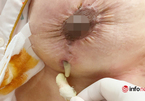 Bác sĩ thẩm mỹ phát hoảng với bộ ngực lở loét, chảy dịch của bệnh nhân