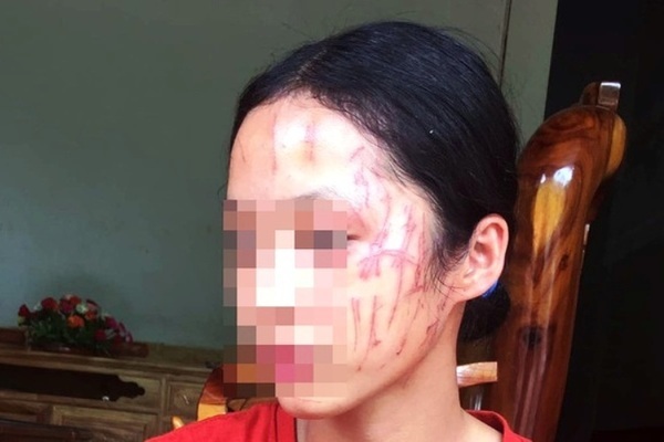 Nghệ An: Em gái bị “bắt nạt”, 2 nữ sinh THCS lao vào cào cấu