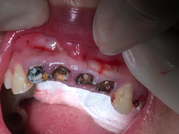 bọc răng sứ,bệnh răng miệng,tụt lợi,hôi miệng,bác sĩ,bệnh nhân