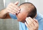 Chuyên gia Mỹ giải thích nguyên nhân rụng tóc khi căng thẳng