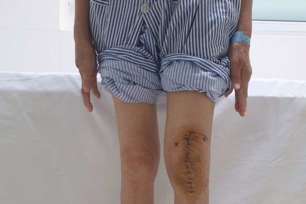 Lần đầu tiên ở Việt Nam mổ thay khớp gối cho bệnh nhân lao khớp