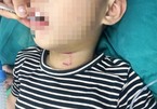 Nghệ An: Bé trai 3 tuổi bị chó cắn rách vùng cổ, thủng khí quản