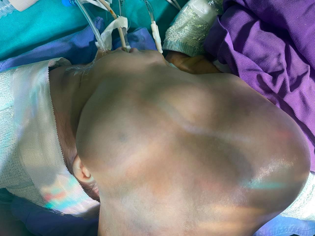 Phẫu thuật khối u bạch huyết khổng lồ cho bé trai mới 1 tháng tuổi