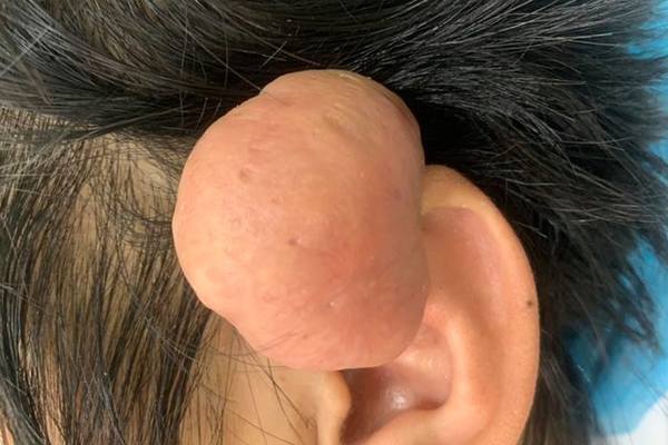 Quảng Nam: Phẫu thuật thành công khối u sụn vành tai lớn hiếm gặp cho bệnh nhân