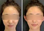 Giới trẻ Trung Quốc đổ xô đi phẫu thuật 'tai yêu tinh'