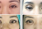 Cắt mí có 'cắt' được tiền duyên?