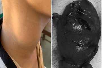 Quảng Nam: Phẫu thuật lấy khối u lớn hiếm gặp ở vùng cổ bệnh nhân 13 tuổi