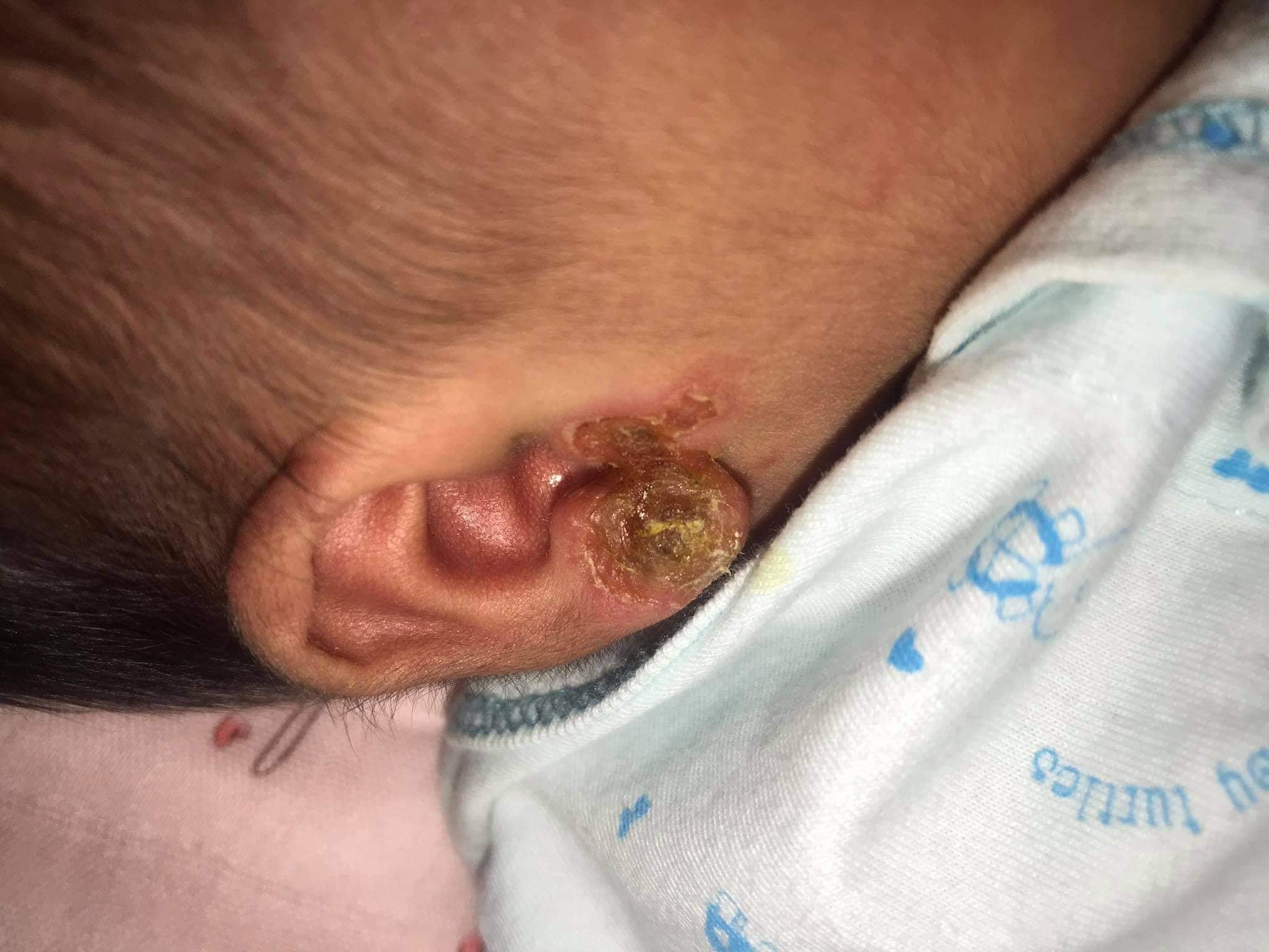 Bé sơ sinh nhiễm trùng vành tai vì xỏ khuyên, biến chứng đáng sợ nhất là gì?