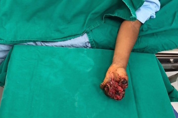 Trẻ 8 tuổi dập nát bàn tay vì trò nghịch dại, bác sĩ đưa ra cảnh báo bố mẹ cần lưu tâm