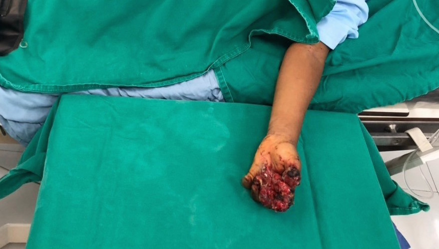 Trẻ 8 tuổi dập nát bàn tay vì trò nghịch dại, bác sĩ đưa ra cảnh báo bố mẹ cần lưu tâm