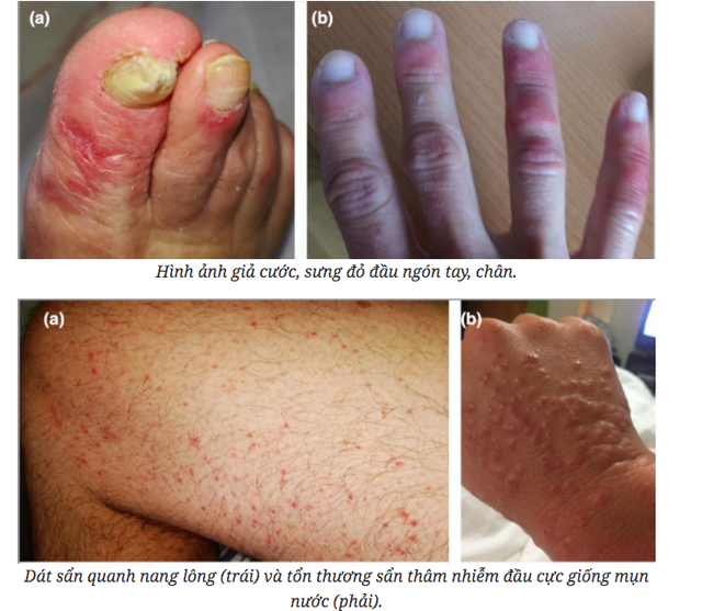 Ngoài ho, sốt, bạn cần lưu ý 6 biểu hiện trên da của bệnh Covid-19