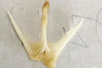 Gắp xương cá 4 chấu trong thực quản bệnh nhi 19 tháng tuổi