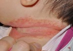 Ngại dịch Covid-19, bố mẹ tự tắm lá chữa viêm da, bé 21 tháng tuổi loét hết cổ