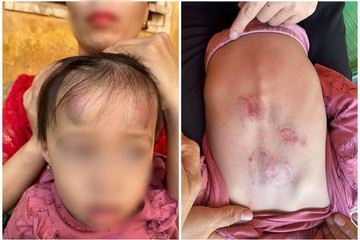 Bé gái 2 tuổi bị bạn học đánh ở Bắc Giang: Ảnh hưởng tâm lý mới là điều đáng lo!