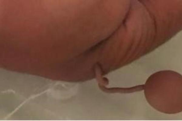 Kỳ lạ em bé ở Brazil sinh ra có đuôi dài 12 cm