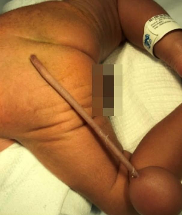 Kỳ lạ em bé ở Brazil sinh ra có đuôi dài 12 cm