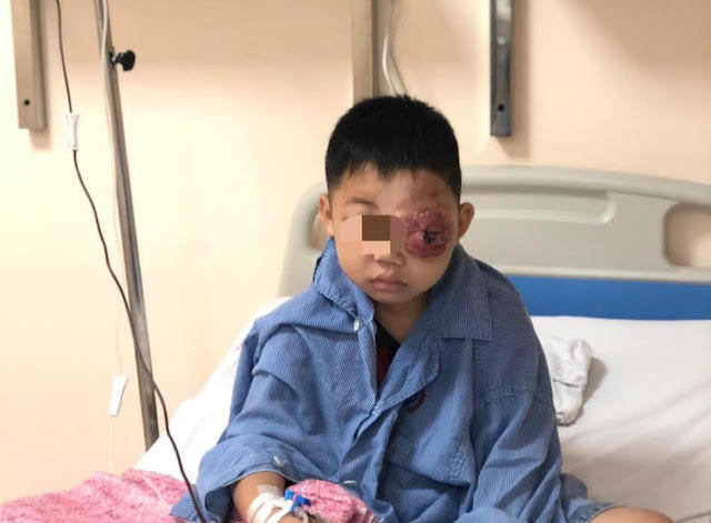 Xót xa cảnh bé 8 tuổi người Dao có khối u khủng ở mắt, máu chảy xuống cả áo quần