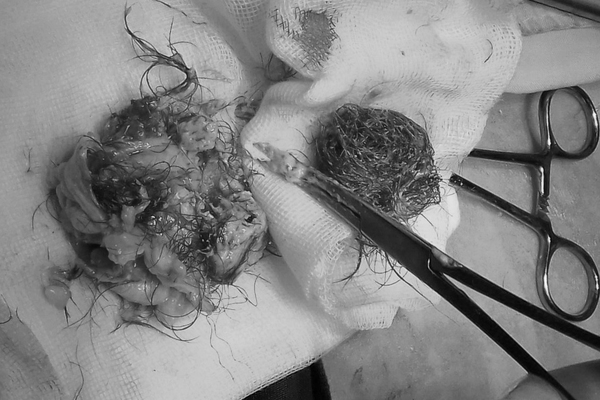 Thiếu nữ 19 tuổi có khối u quái chứa đầy lông, tóc, xương