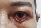 Lấy bọng mỡ mắt ở spa dởm, người phụ nữ 5 năm chịu cảnh 'địa ngục trần gian' vì cặp mí lật ngược