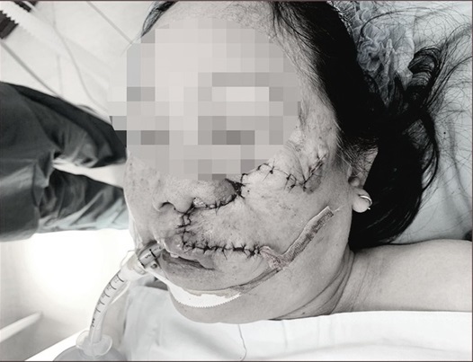 Quảng Nam: Nghẹt mũi vì nốt ruồi trên môi cứ lớn dần, nữ bệnh nhân 'choáng' khi biết nguyên nhân