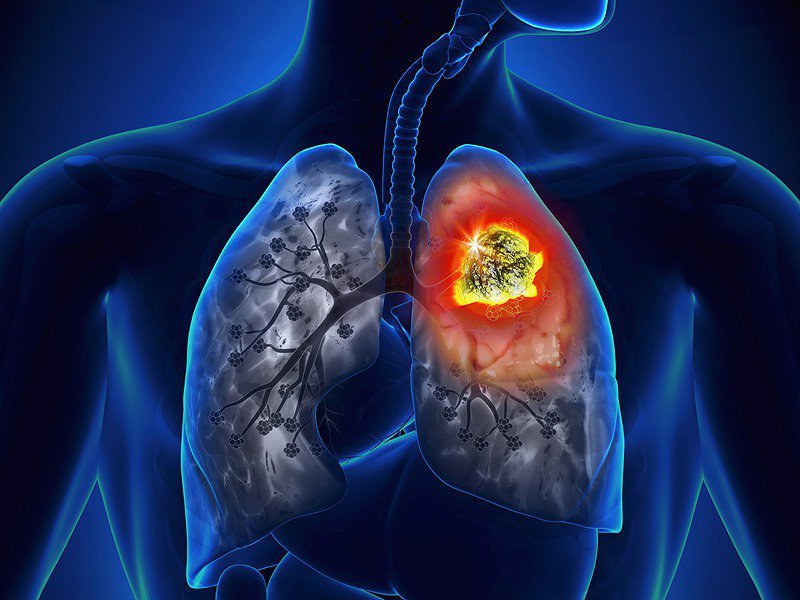 'Chết điếng' vì đau lưng đi khám lại ra ung thư phổi giai đoạn cuối