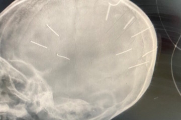 Bé gái 3 tuổi hôn mê, nguy cơ tử vong cao nghi ngờ bị bạo hành với hình ảnh phim X-quang nhiều đinh bắn vào sọ