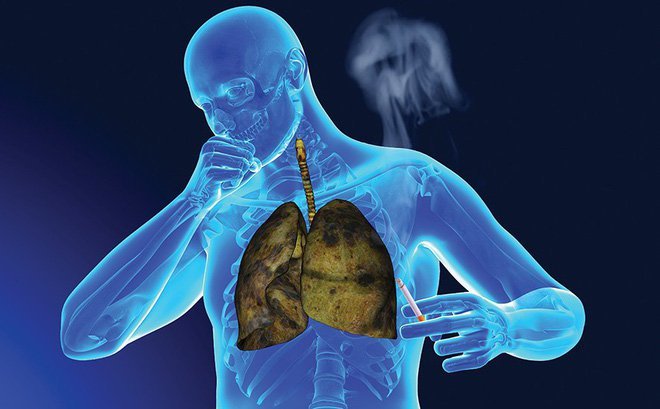 NSƯT Tiến Hợi qua đời vì ung thư phổi: Ai dễ mắc căn bệnh này?