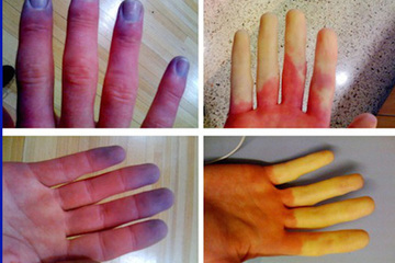 Bác sĩ cảnh báo căn bệnh khiến bàn tay biến sắc mỗi khi gặp lạnh, không phòng để nặng có thể hoại tử