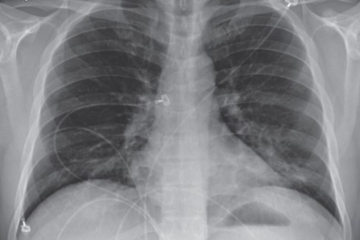Tổn thương phổi hậu Covid-19, SpO2 chỉ còn 80%, sau 3 ngày hồi sức tích cực bệnh nhân không qua khỏi