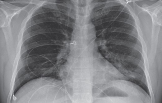 Post-Covid-19 lung damage, SpO2 was only 80%, after 3 days of intensive resuscitation, the patient did not survive