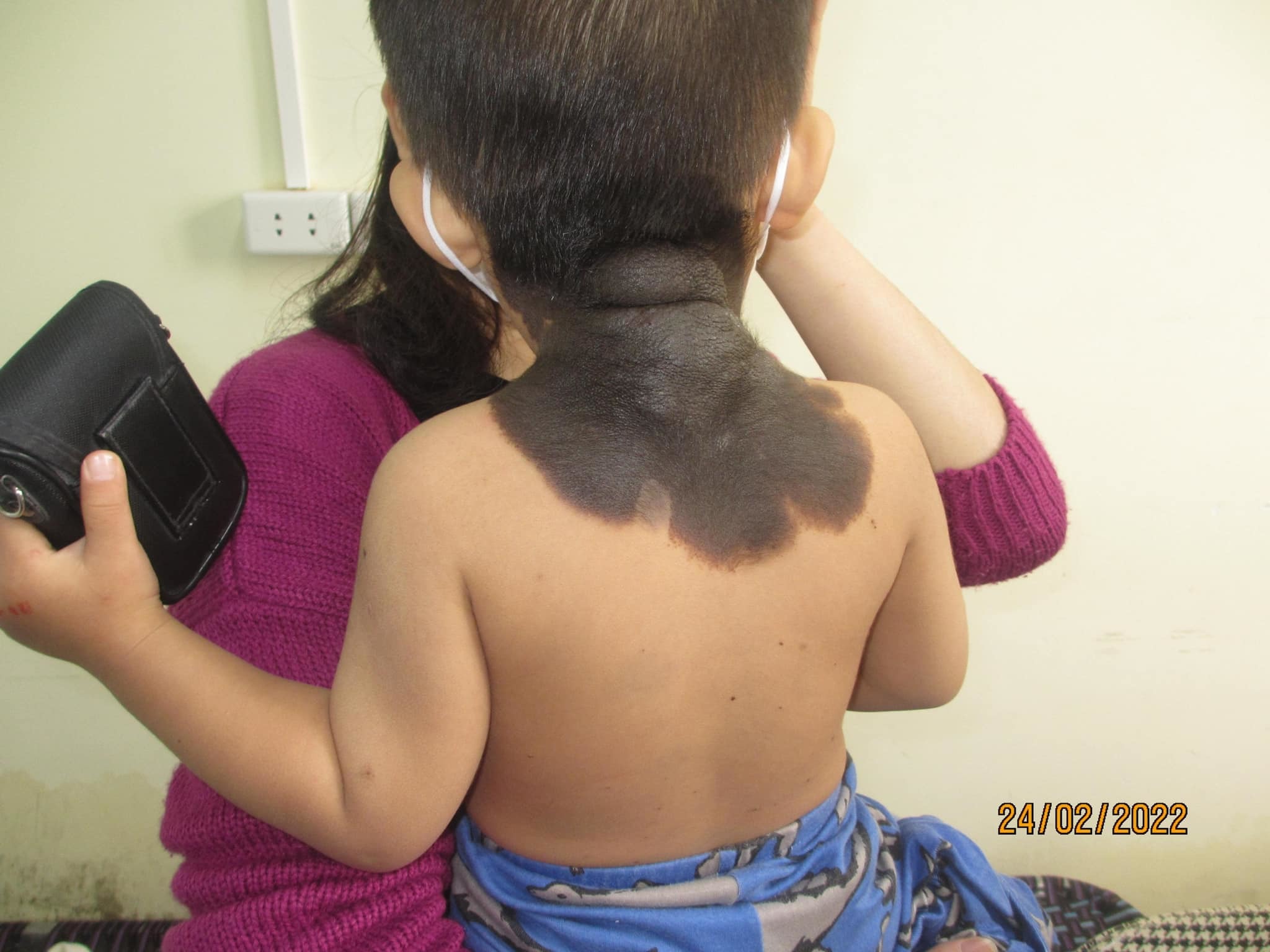 A 2-year-old boy has a black “big” birthmark that fills the back of his neck, the doctor points out the cause