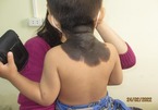 Bé trai 2 tuổi có da cổ gáy như da trâu, bác sĩ chỉ ra nguyên nhân