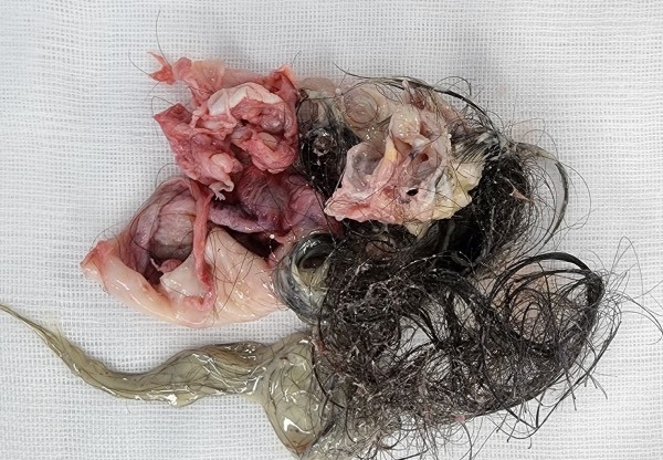 A 14-year-old girl with an ovarian tumor filled with hair, skin, and cartilage