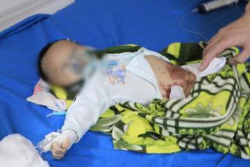 Đắp tỏi điều trị Covid-19, bé sơ sinh 2 tháng tuổi nhập viện cấp cứu trong tình trạng nguy kịch
