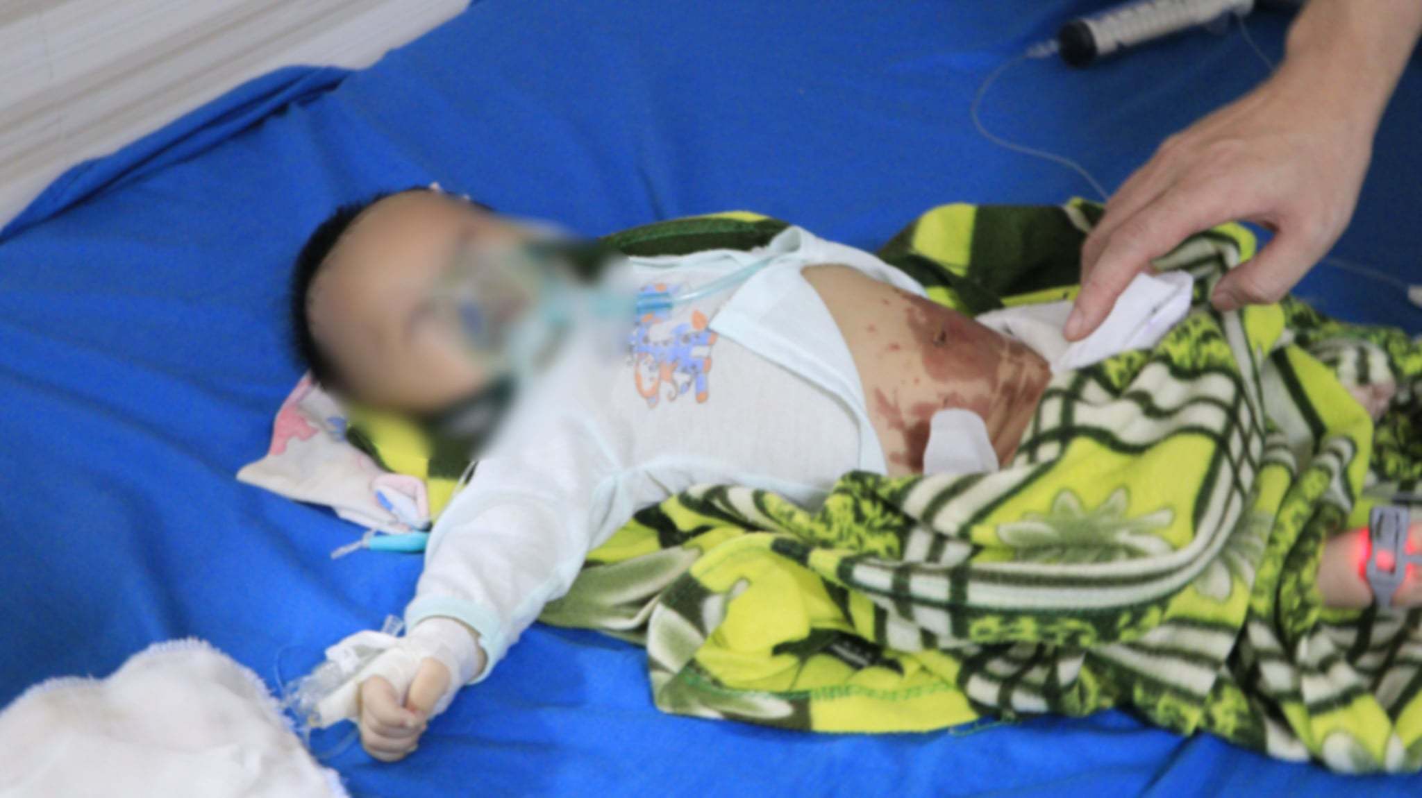 Đắp tỏi điều trị Covid-19, bé sơ sinh 2 tháng tuổi nhập viện cấp cứu trong tình trạng nguy kịch