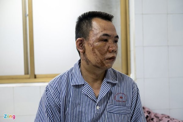 Quang Ninh: The story of a man who was doused with acid after an argument