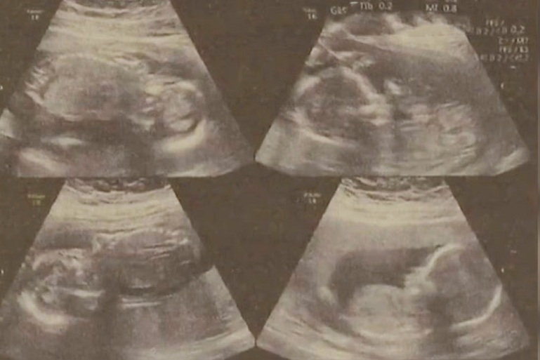 Người mẹ sinh 2 con vào 2 ngày khác nhau, vẫn còn 2 bào thai khác trong bụng