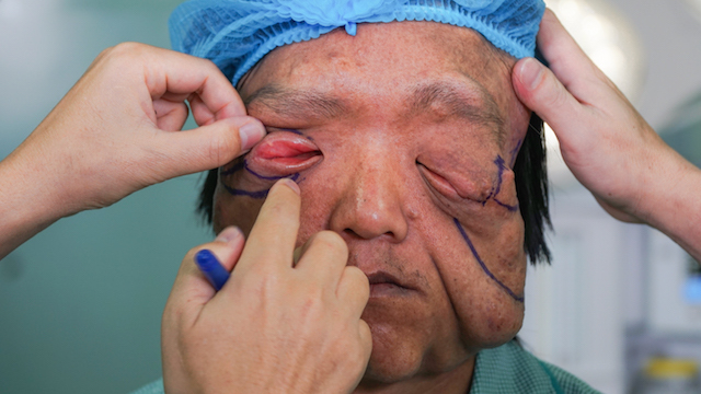 Poor Dao ethnic boy has a sagging tumor, blind in one eye, he has to draw out the tumor in the other eye